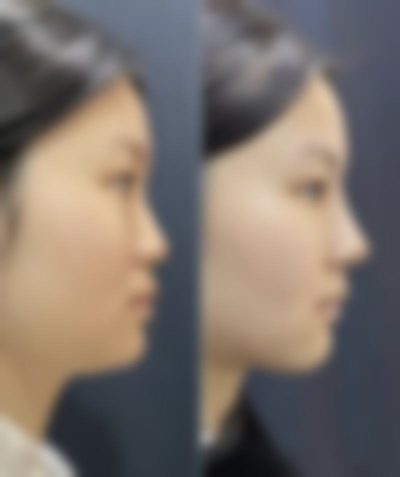 一、割完双眼皮怀孕时间的总体建议