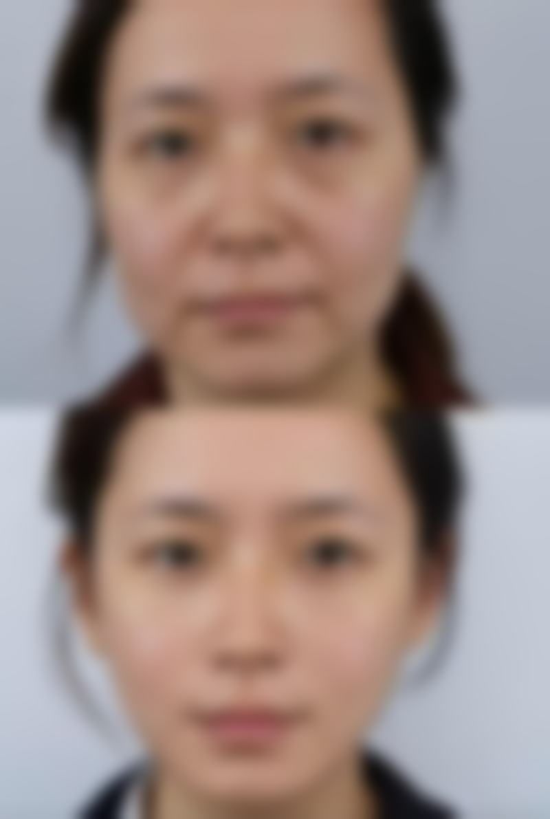 三、不同术式的修复周期参考