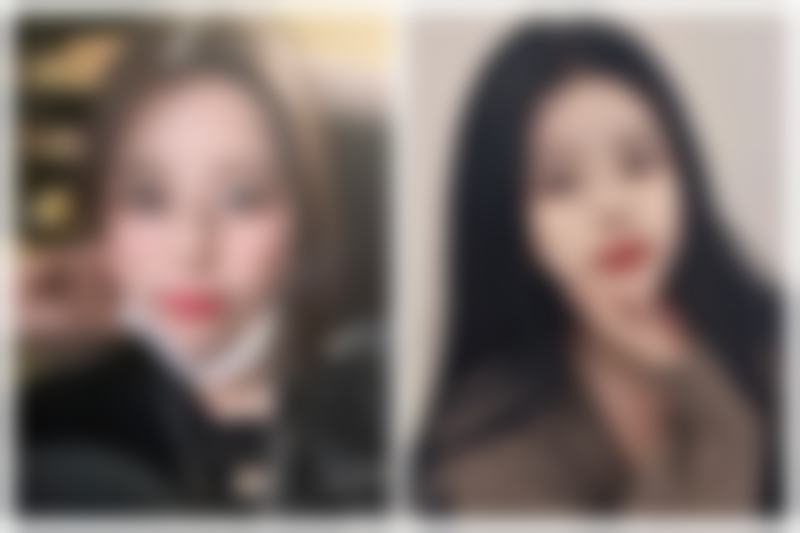 二、怎样才能出双眼皮：手术方法全解析