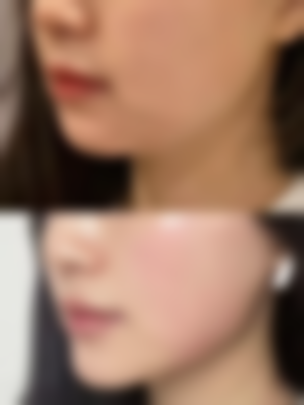 四、隆鼻打哪个玻尿酸好？美学设计特别重要