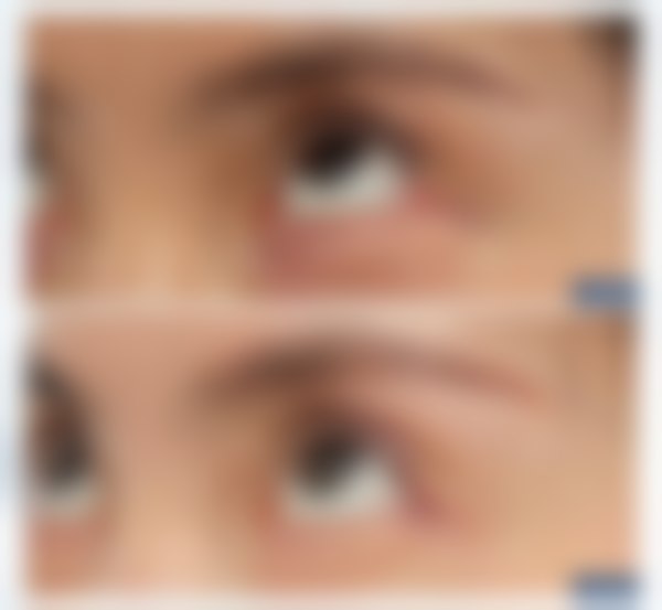 上海爱尚丽格杜园园医生开内眼角项目26500元，精塑眼形美化眼部比例 