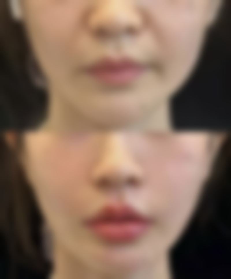 疤痕体质的人可以做埋线双眼皮吗？看完视频了解手术风险与替代方案 