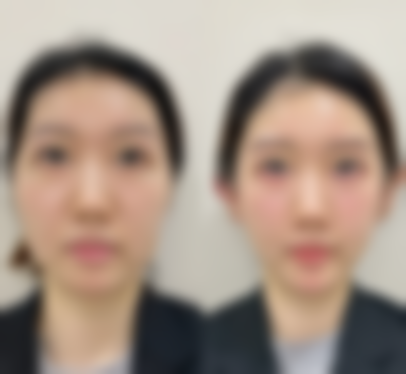 四、打水光眼袋肿了的风险提示与就医建议