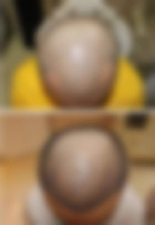 四、曲靖新生植发特色项目