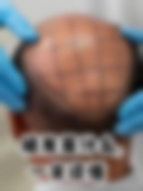 七、兰州青丝亿植发诊所预约方式