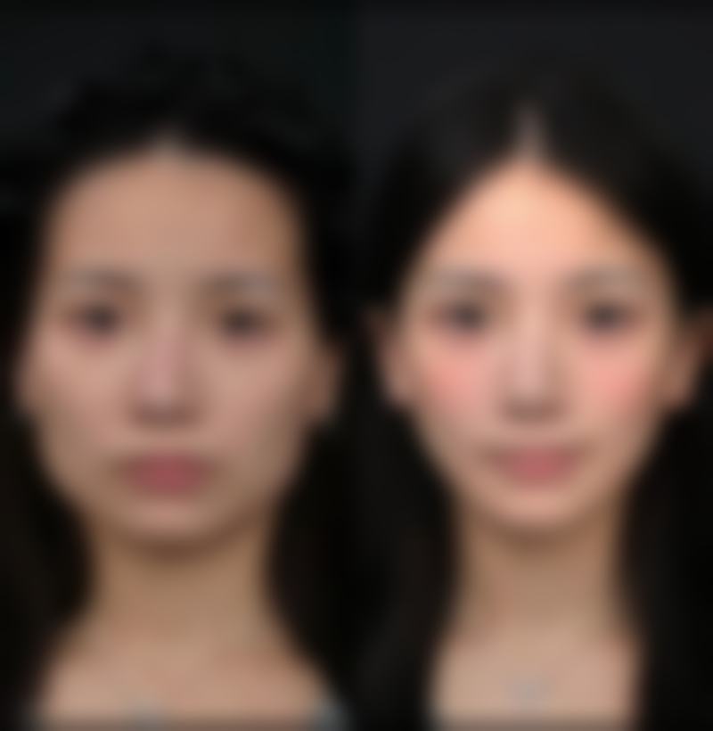 二、疤痕修复的关键阶段