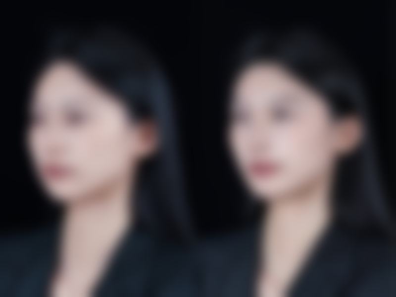 五、埋线双眼皮术后的美观注意事项