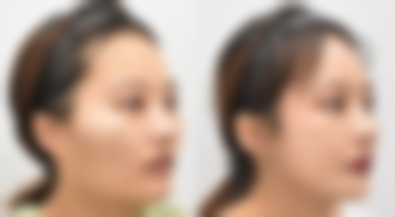 三、更有效的疤痕管理方案