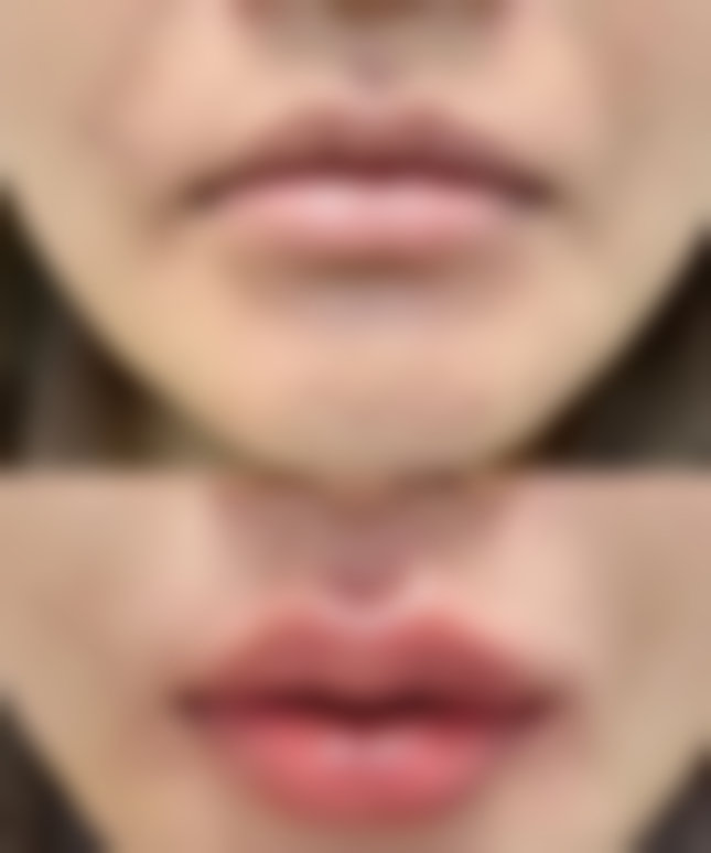 五、金眼霜与其他去眼袋方法的对比