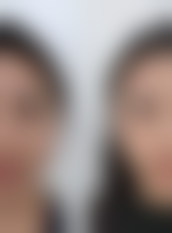 三、割双眼皮术后护理的三大重点