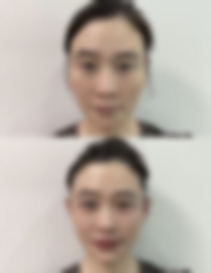 下巴吸脂手术危险吗？了解风险与预防措施，安全变美不是梦！ 