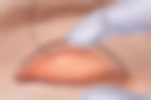 三、影响除皱针见效时间的因素