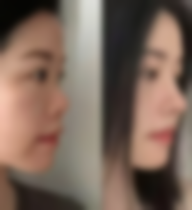 五、隆胸脂肪填充的风险及应对措施