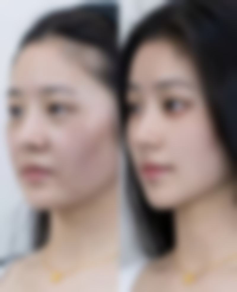 双眼皮手术后忌口多久合适？分阶段饮食建议助你科学恢复收获自然美眼 