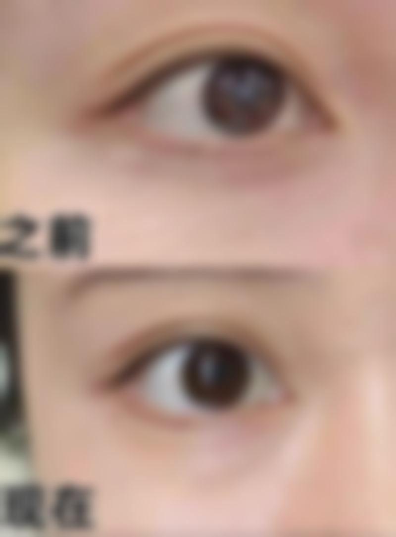 二、隆胸脂肪填充的优势