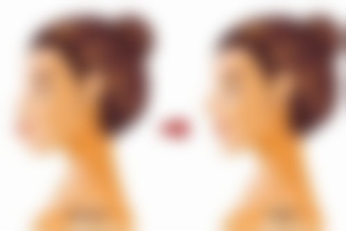 四、双眼皮全切能保持多久之美学角度的考虑