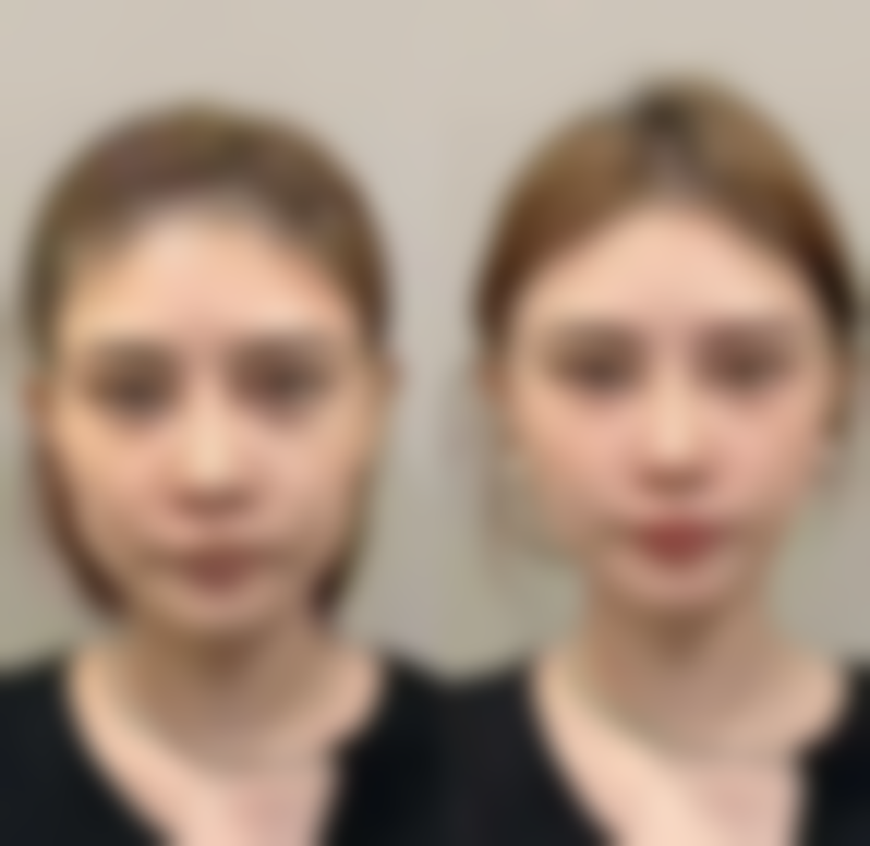 五、剖腹产十年后怀孕在疤痕处的情况