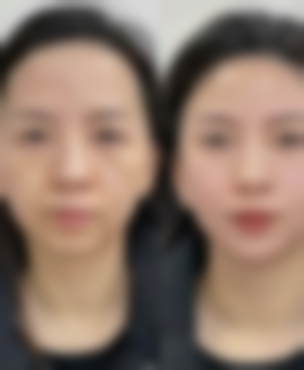 疤痕体质疤痕增生能治好吗？