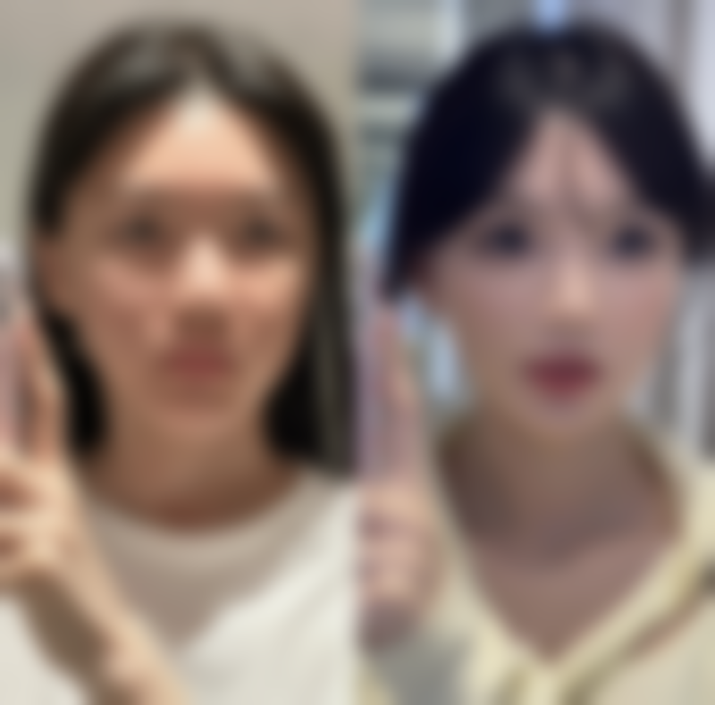 三、双眼皮全切能保持多久之影响维持时长的关键因素