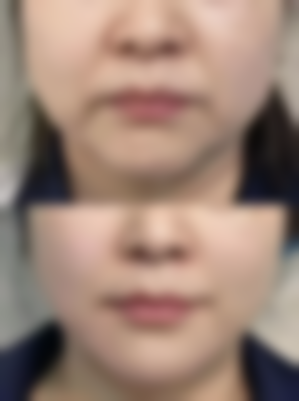 一、抽脂后疼痛修复的大致时间