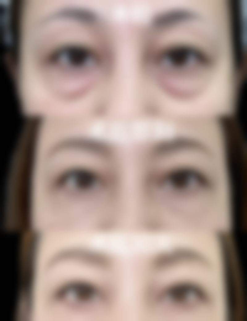 二、二次修复的注意要点