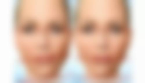 20年的老疤痕能治吗？现代医美手段可显著改善但难以完全去除！ 