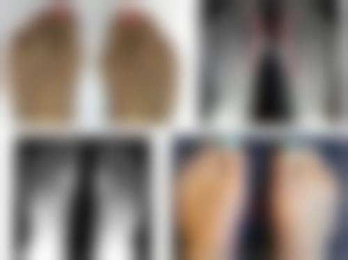 六、20年的老疤痕能治吗：结尾总结