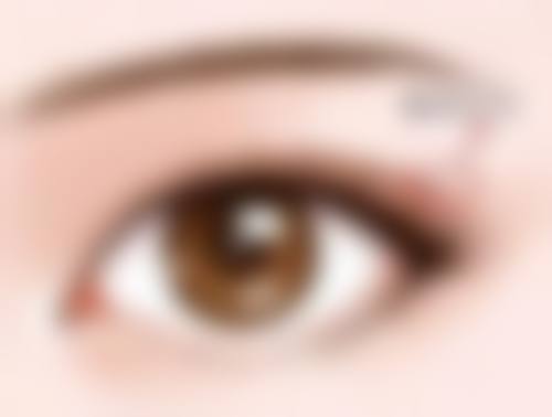 三、20年的老疤痕修复方法