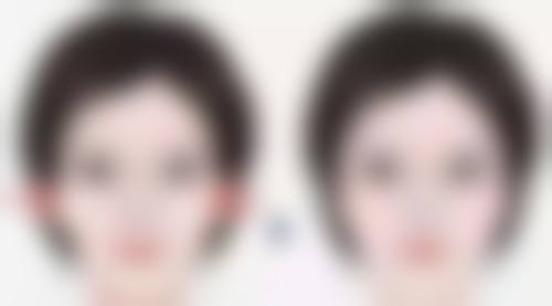 二、点阵激光能把凹陷疤痕打平吗之影响成效的关键因素