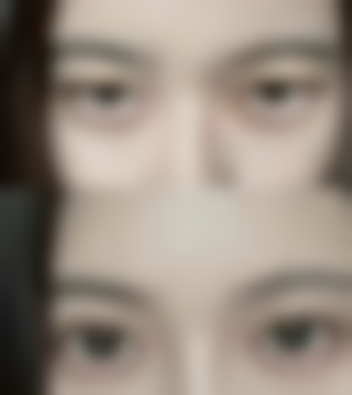 二、全切双眼皮术后不同阶段的饮食建议