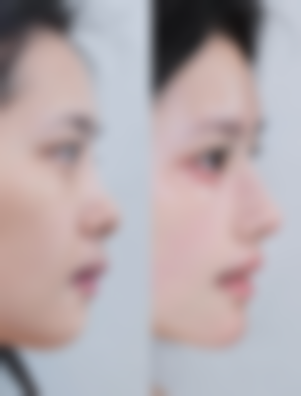 一、了解黑眼圈和眼袋形成的原因