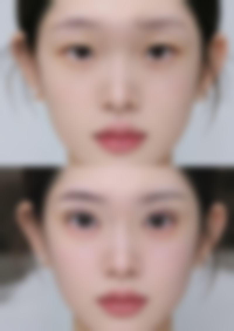 女人怎么样去除眼袋最有效？日常护理与医美手段双管齐下帮你告别眼袋烦恼