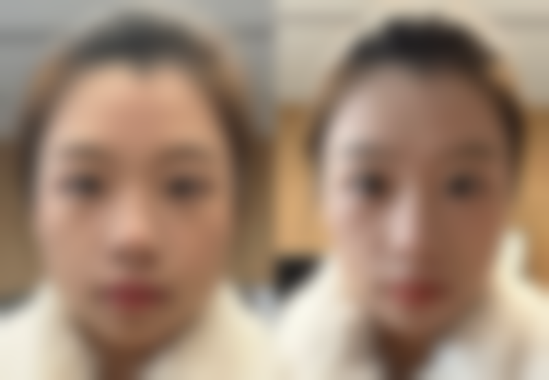 五、女人怎么样去除眼袋：术后护理与注意事项