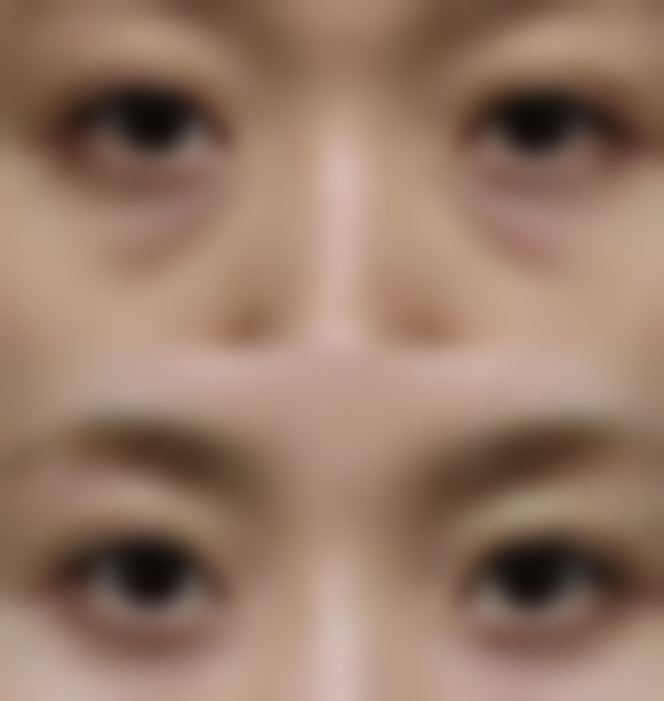 五、20年的老疤痕修复注意事项