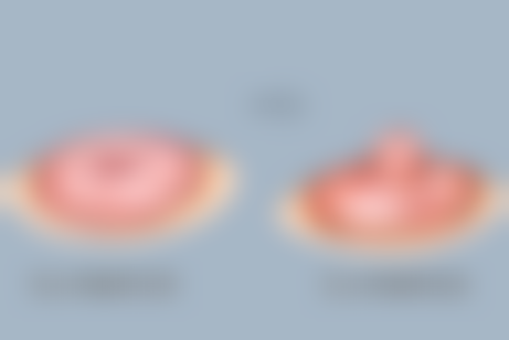 一、什么是眼袋筋膜悬吊术：手术概述