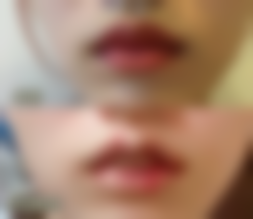 四、理性看待假体隆胸手术