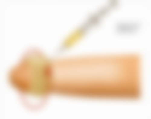 七、什么是眼袋筋膜悬吊术：修复过程与维持时间