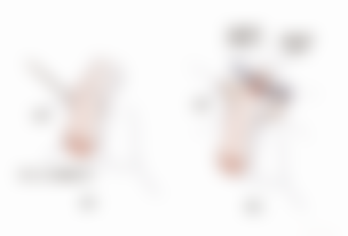 一、抽烟对术后修复的主要影响