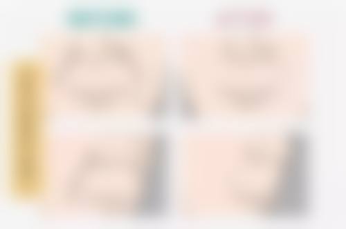 五、什么是眼袋筋膜悬吊术：适用人群和常见原因