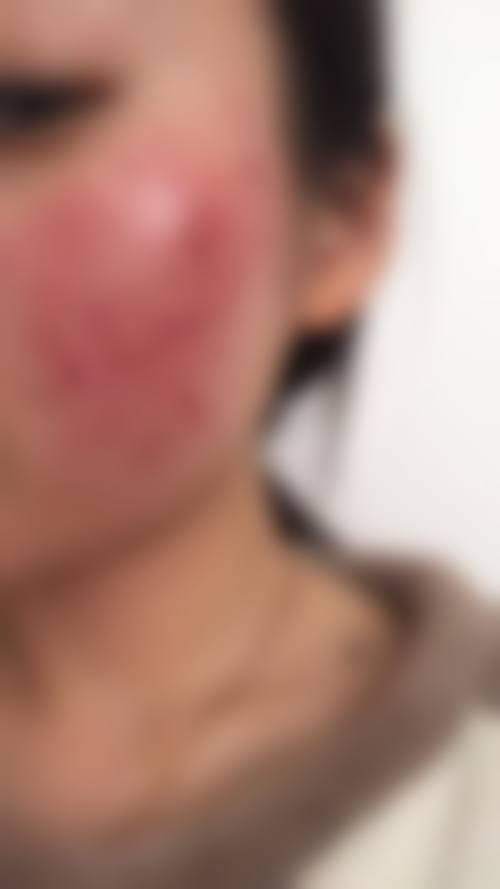 九、广东药学院附属非常好医院激光美容整形中 心真实的患者评价