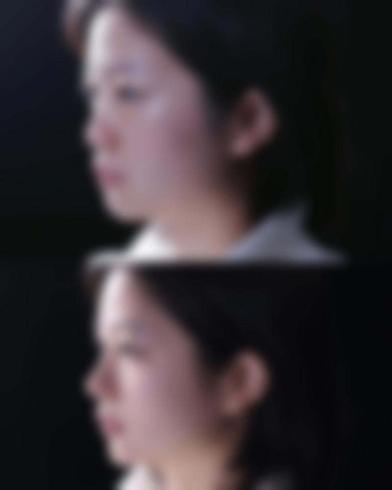 一、二十年的烫伤疤痕为何难以消除