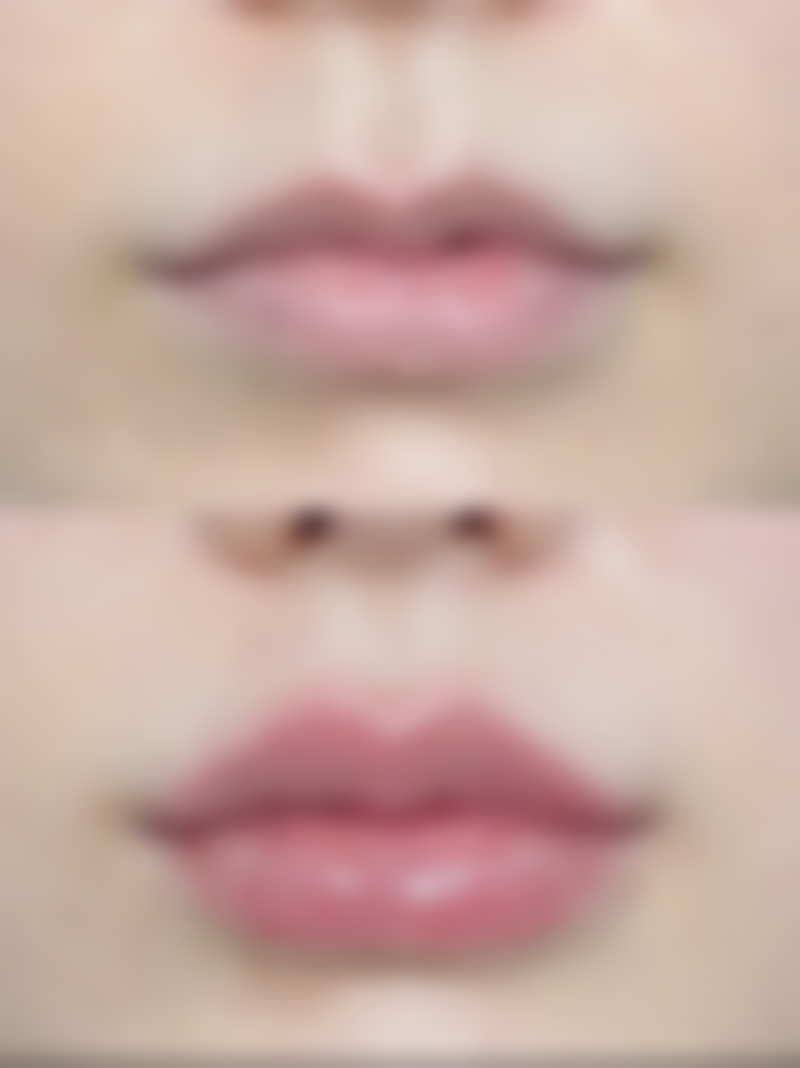 三、双眼皮疤痕不同修复阶段的表现及护理重点