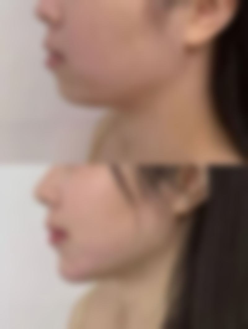 二、影响深二度烫伤疤痕修复时间的因素