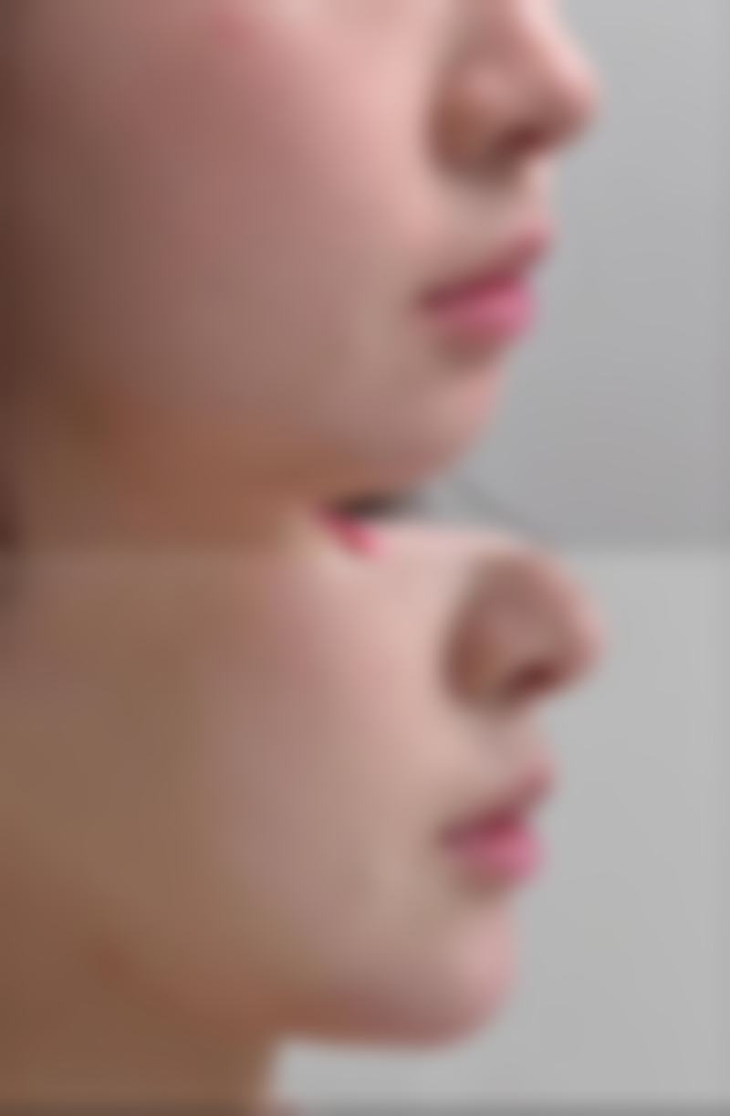 二、影响双眼皮疤痕消失的因素