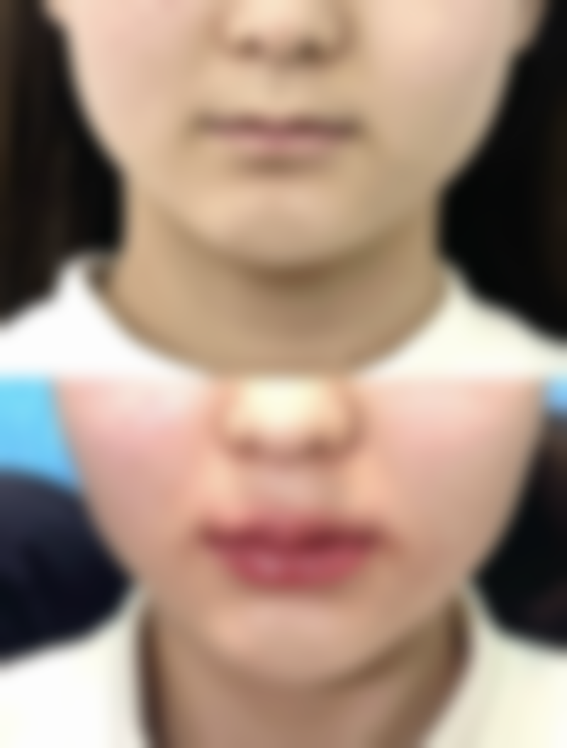 四、关于双眼皮疤痕的美学提示