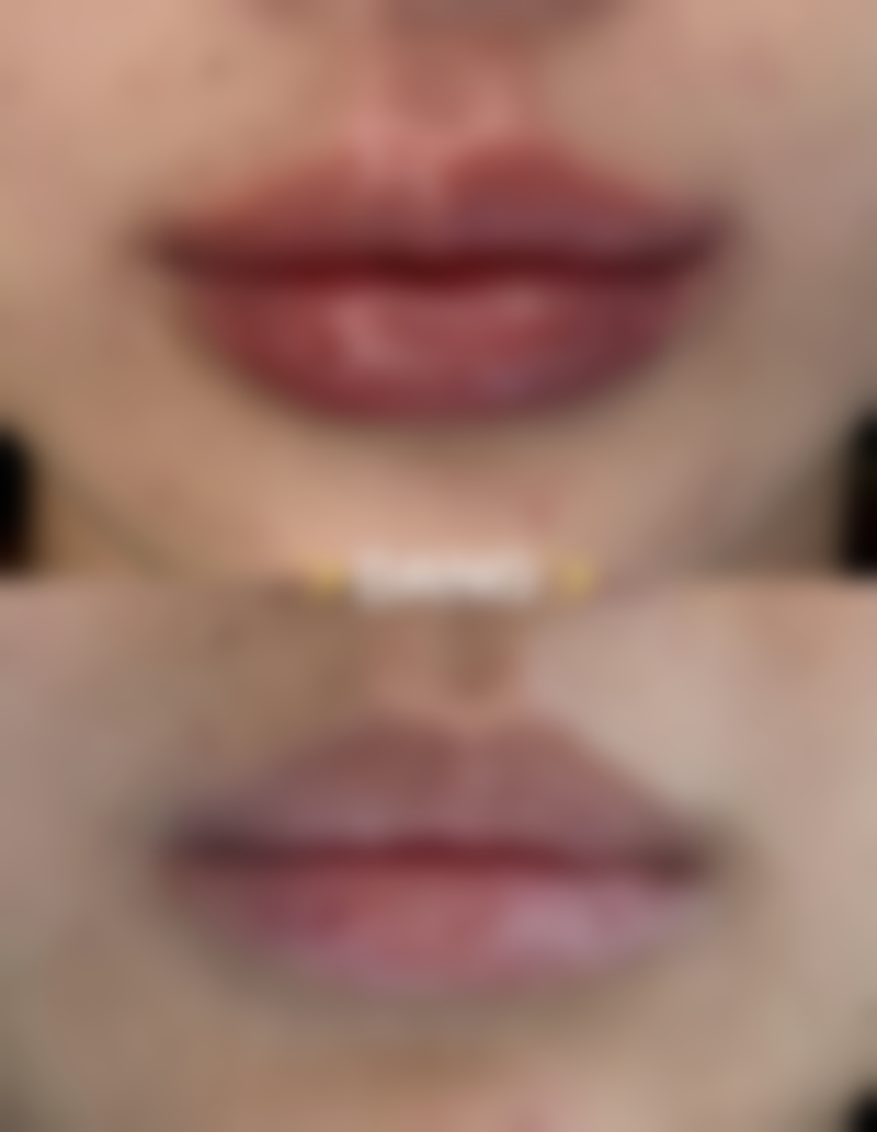 埋线双眼皮线紧慢慢会恢复吗？多数情况可改善，一般3 - 6个月恢复自然 