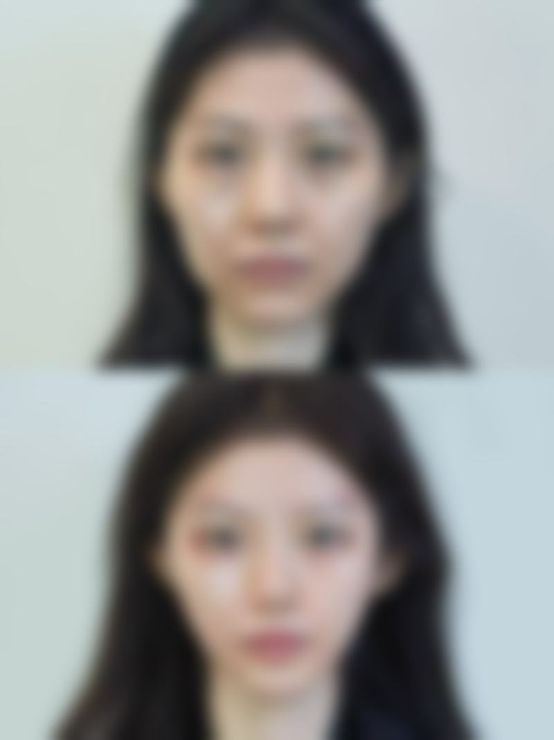 二、正常疤痕的三阶段特征