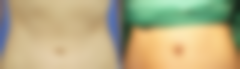 三、做去眼袋手术之美学与风险提示