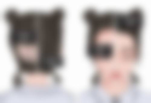 二、增生性疤痕能否去除的影响因素