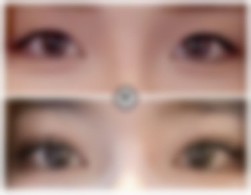 三、压力疗法怎么治疗疤痕体质留下的疤痕